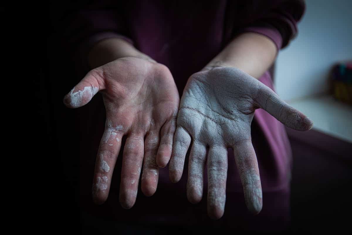 dermatite psoriasis