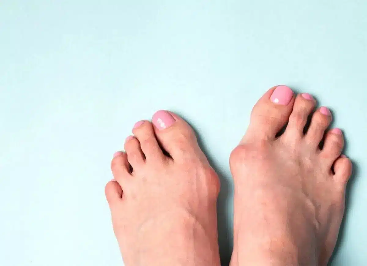 Hallux valgus