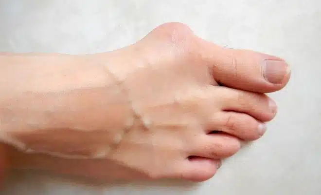 Hallux valgus